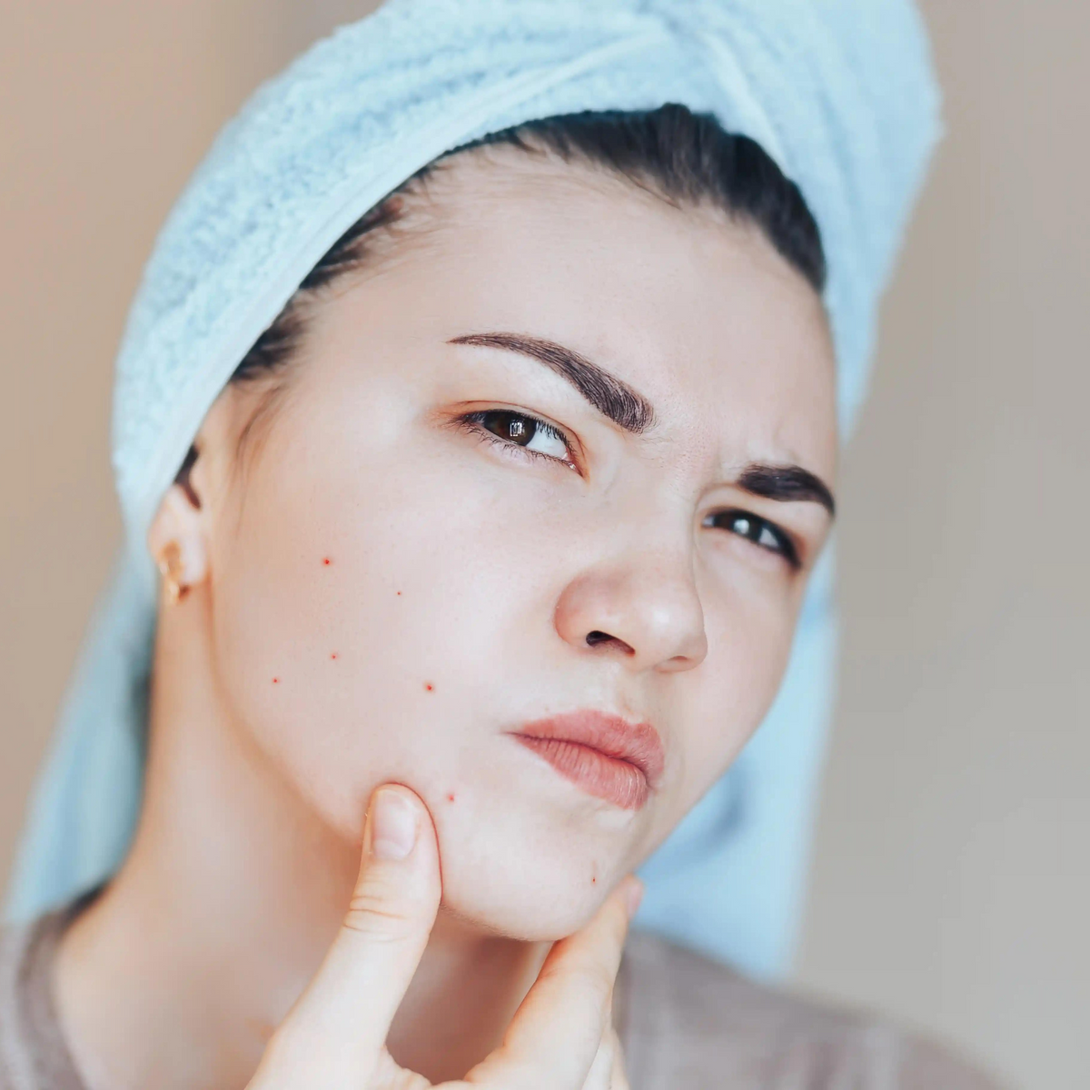 L'acné hormonale : tout savoir pour s'en débarrasser | Nidéco