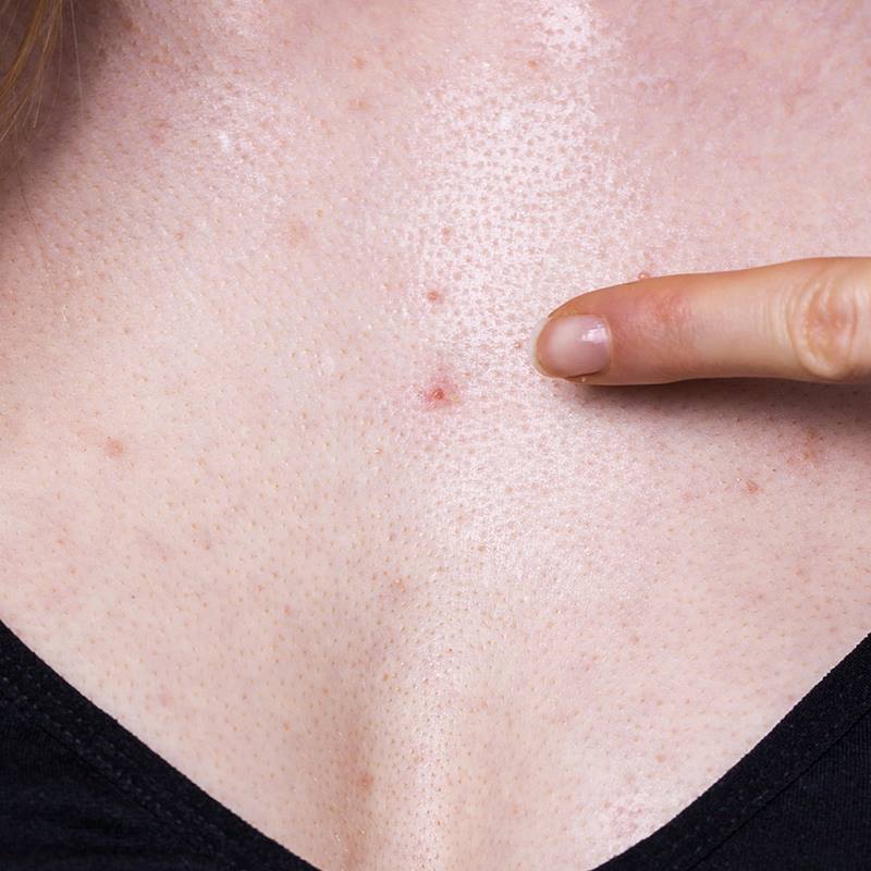 L'acné du corps, comment s'en débarasser ?