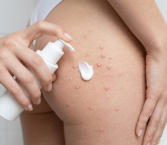 Boutons blancs sur les fesses : ce que ça veut dire