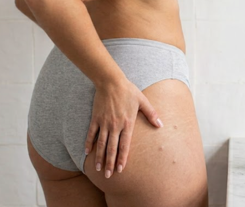 Boutons sur les fesses chez la femme : causes et solutions