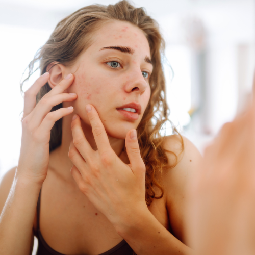 La routine anti acné, pour une peau sans boutons