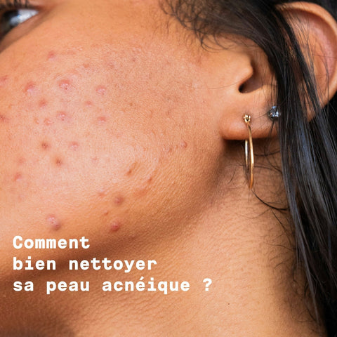 Come si pulisce la pelle a tendenza acneica?