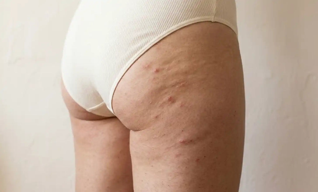Bouton entre les fesses : reconnaître la cause et savoir quoi faire