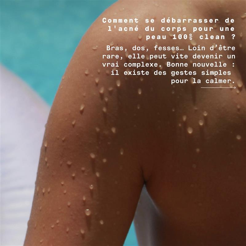 Come eliminare l'acne dal corpo?