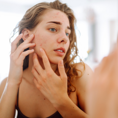 La routine anti-acne, per una pelle senza brufoli